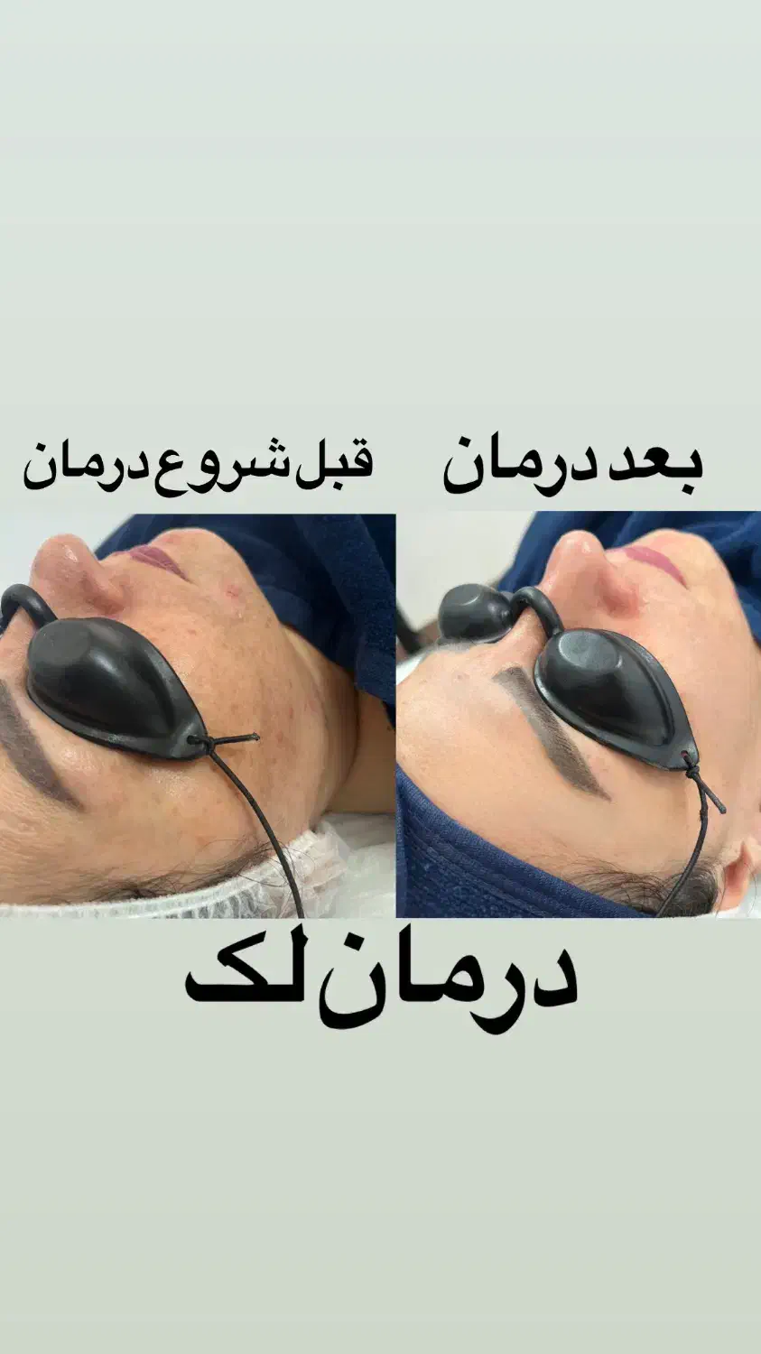 پاکسازی پوست به صورت حرفه ای فقط ۴۰۰ت|خدمات آرایشگری و زیبایی|قائمشهر, |دیوار