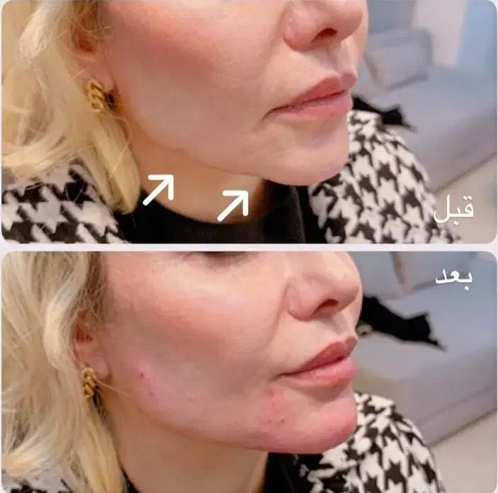 خدمات زیبایی تزریق بوتاکس و فیلر prp مزوژل|استخدام درمانی، زیبایی، بهداشتی|کرمانشاه, |دیوار