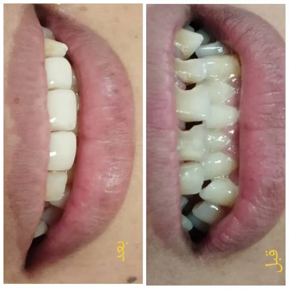 تخفیفات ویژه کامپوزیت در درمانگاه تخصصی یاسوج|خدمات آرایشگری و زیبایی|یاسوج, |دیوار