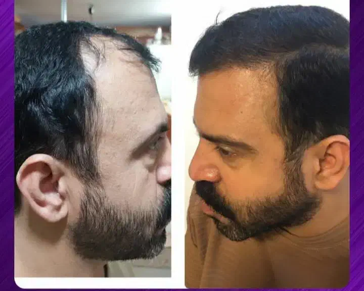 (تخفیف استثنایی کاشتمو)۱۳میلیون(بهعلت قطعیاینترنت)|خدمات آرایشگری و زیبایی|ساری, |دیوار