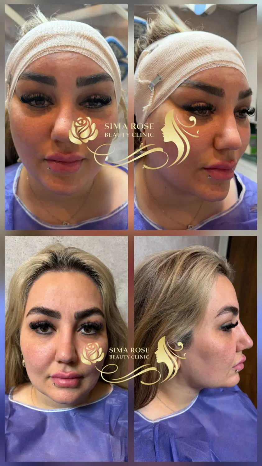 اندولیفت جراحی لیفت شقیقه گونه ابروچشم مینی بلفارو|خدمات زیبایی و سلامت|تهران, بلوار کشاورز|دیوار