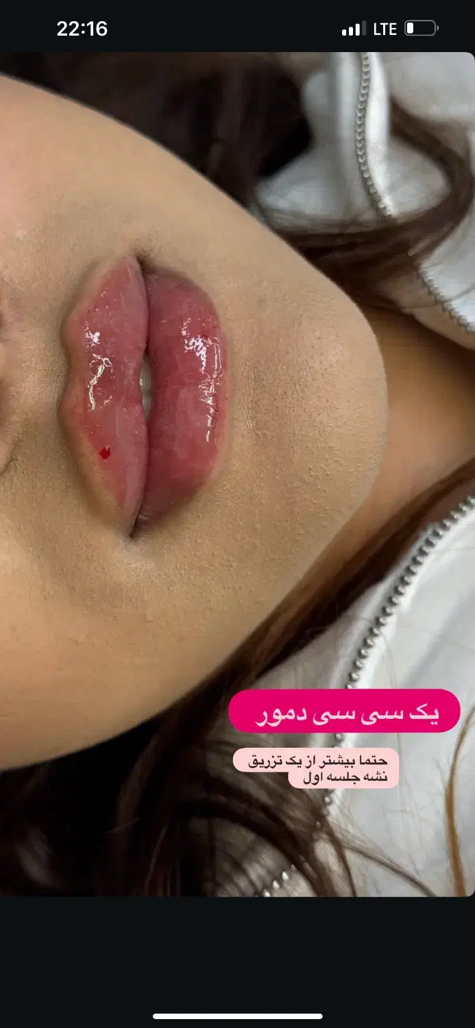 جشنواره ژل و بوتاکس و پی ار پی در مطب توسط پزشک|خدمات آرایشگری و زیبایی|شیراز, چوگیاه|دیوار