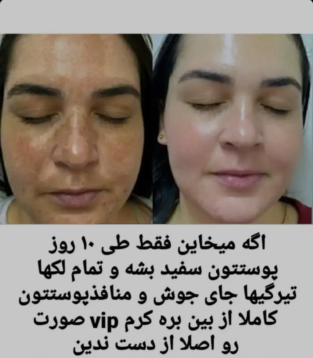 کرم ضدلک و‌جوش و سفید کننده|آرایشی، بهداشتی، درمانی|دهدشت, |دیوار