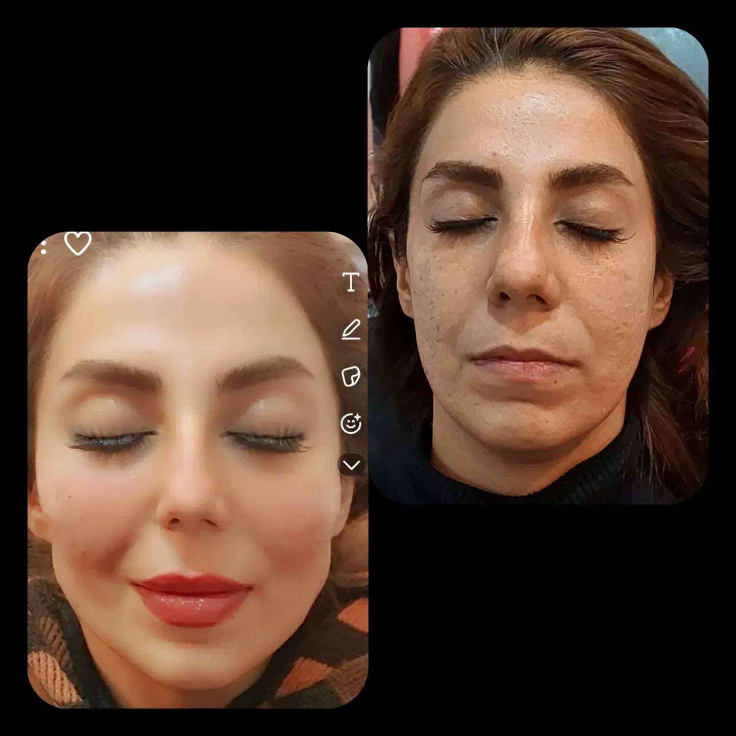 آموزش و تزریق ژل و بوتاکس ومزو|خدمات آموزشی|شیراز, تندگویان|دیوار
