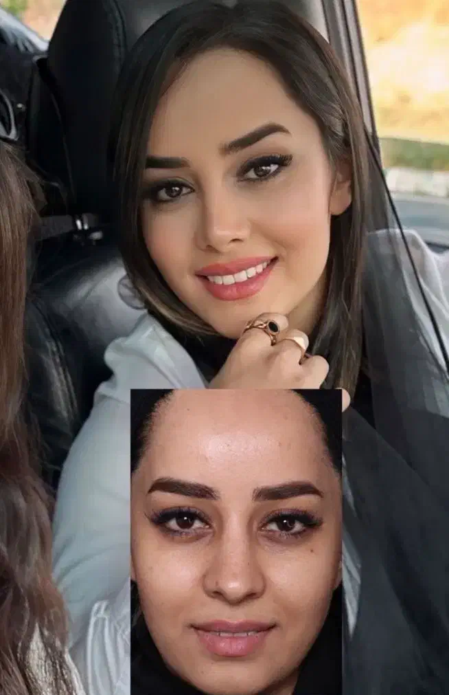 جراحی بینی با قیمت استثنایی|خدمات آرایشگری و زیبایی|بروجرد, |دیوار