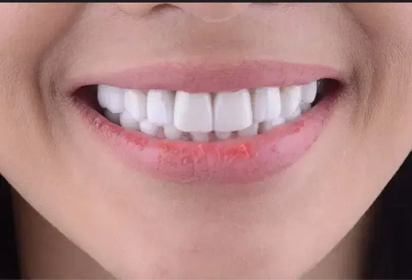 لمینت متحرک دندان|آرایشی، بهداشتی، درمانی|زابل, |دیوار