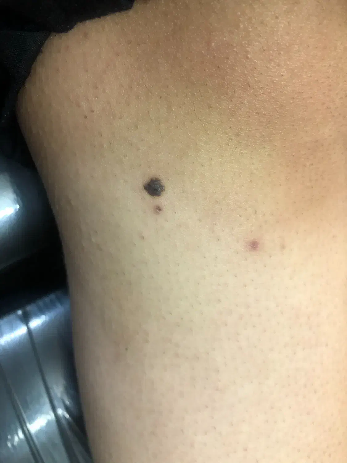 حذف انواع خال (گوشتی،سطحی،زیگیل)|خدمات آرایشگری و زیبایی|کاشان, فاز ۲ ناجی آباد|دیوار