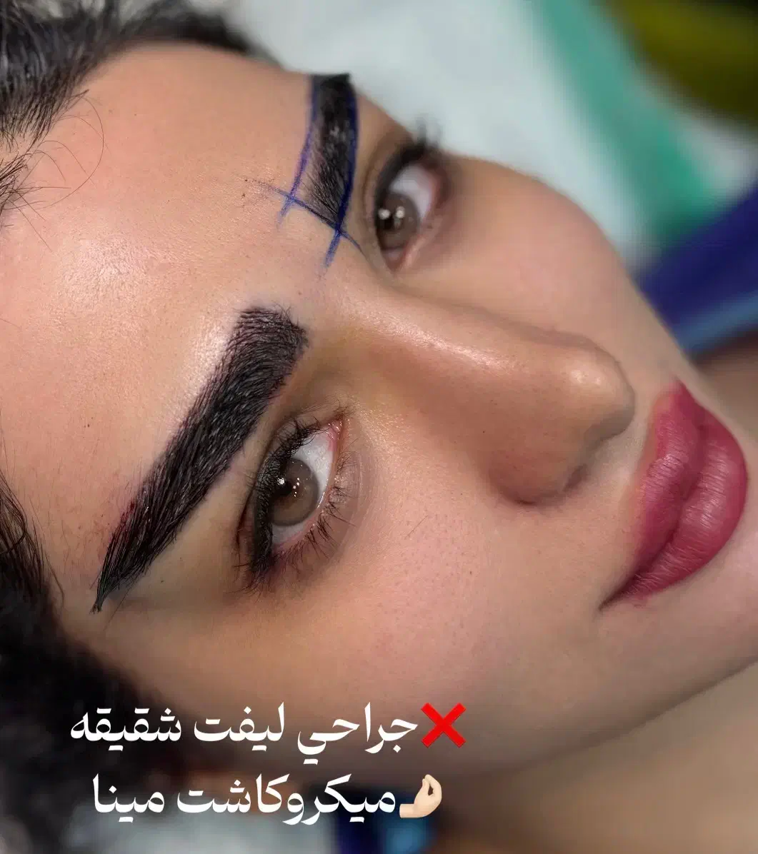 میکروکاشت با و‌بدون جراحی نقد و اقساط|خدمات آرایشگری و زیبایی|یزد, |دیوار