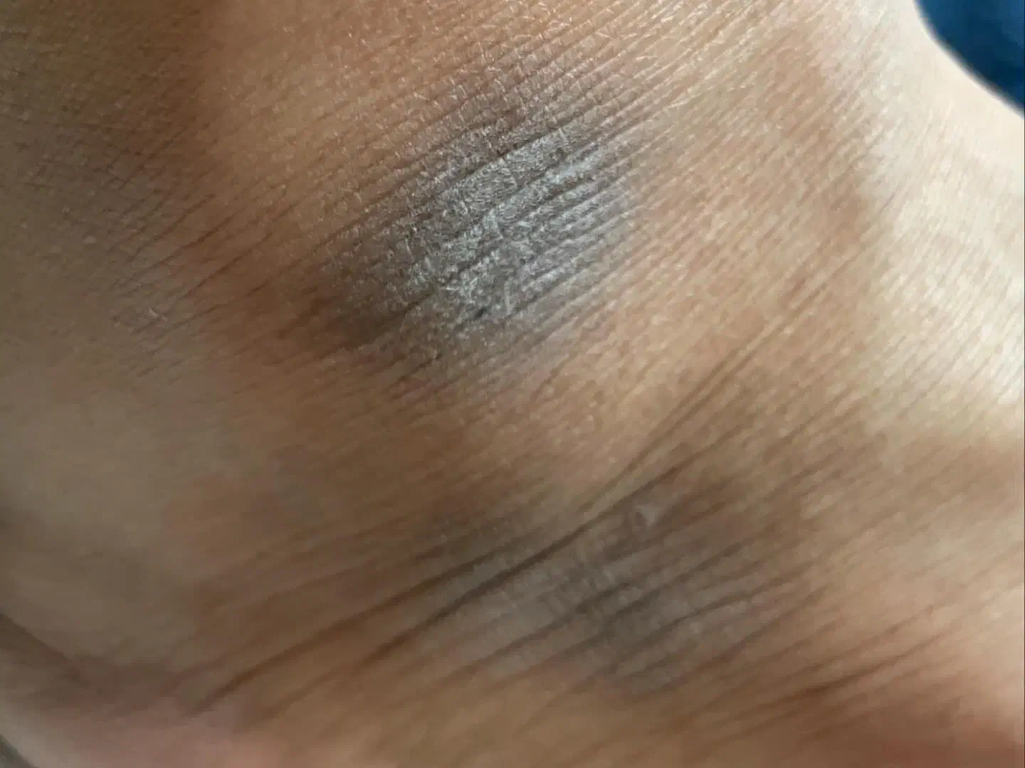 درمان تیرگی های بدن|آرایشی، بهداشتی، درمانی|مشهد, چهارچشمه|دیوار