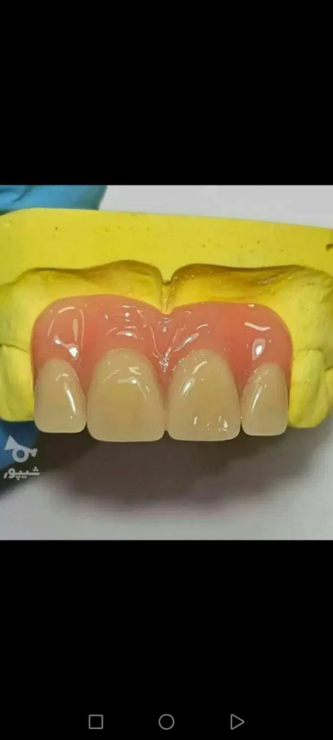 دندانسازی ساخت دندان مصنوعی متحرک باضمانت|آرایشی، بهداشتی، درمانی|مشکیندشت, |دیوار