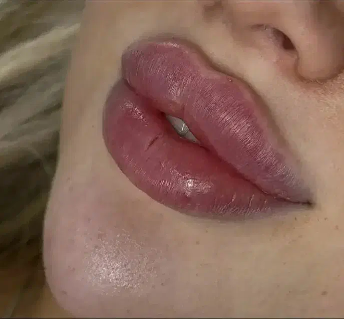 آف بلک فرایدی تزریق ژل بوتاکس فیلر ریمو تتو...|خدمات آرایشگری و زیبایی|علیآباد کتول, |دیوار