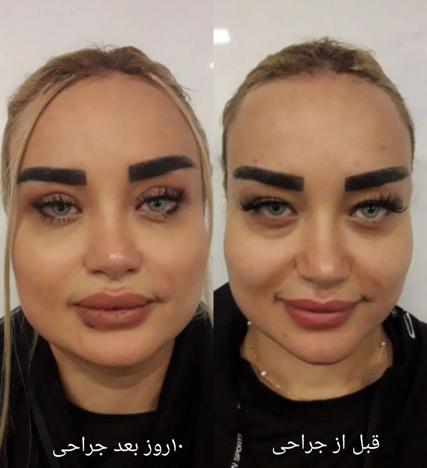 بلفاروپلاستی رفع افتادگی پلک لیزری/سانترال/بوکالفت|خدمات آرایشگری و زیبایی|تهران, هفت حوض|دیوار