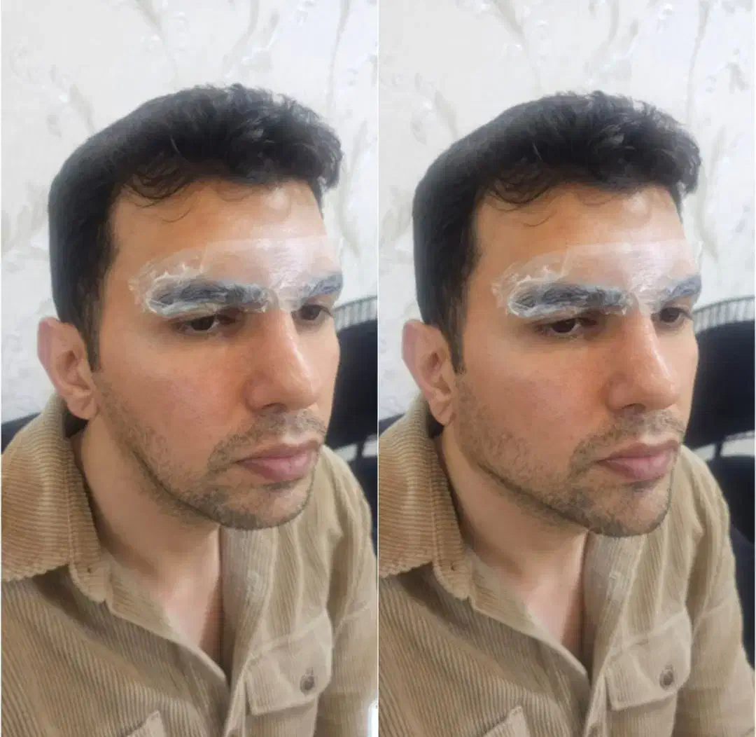 اموزش فیلر و بوتاکس پی ار پی .مزوتراپی|خدمات آموزشی|کرمانشاه, |دیوار