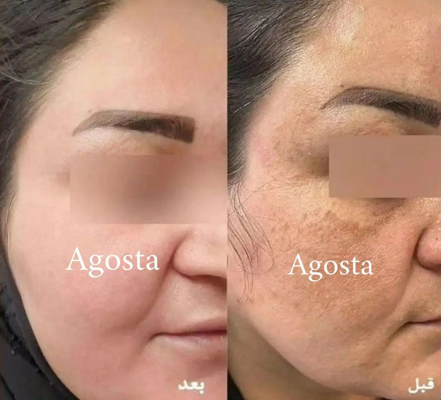 پک ضد لک تخصصی با قدرت آبرسانی بالا|آرایشی، بهداشتی، درمانی|فسا, |دیوار