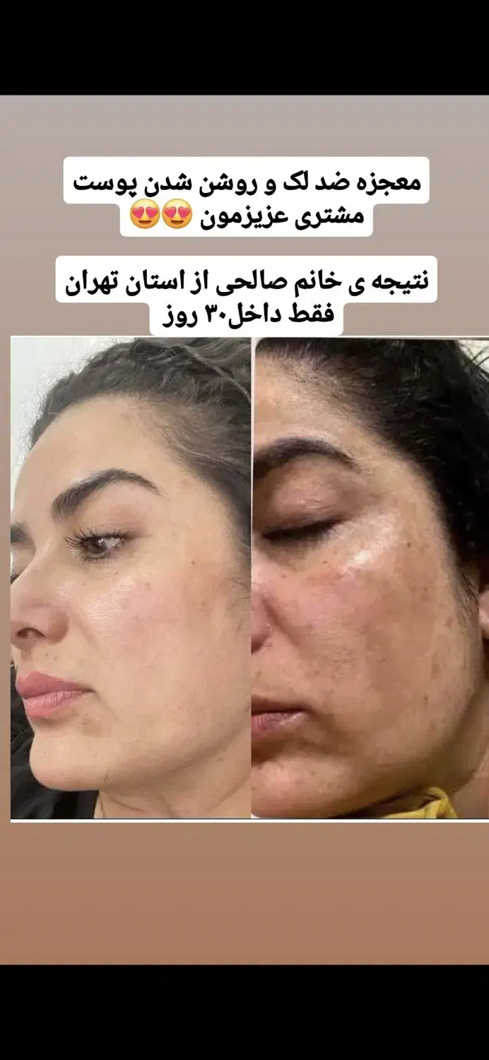 قویترین ضد لک در ایران|آرایشی، بهداشتی، درمانی|بوشهر, |دیوار