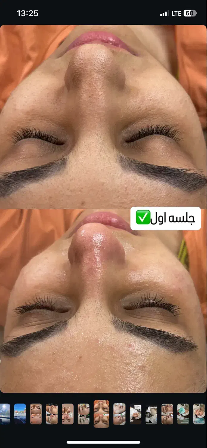 فیشال تخصصی خانم ها واقایان تحت نظر پزشک|خدمات آرایشگری و زیبایی|زاهدان, |دیوار