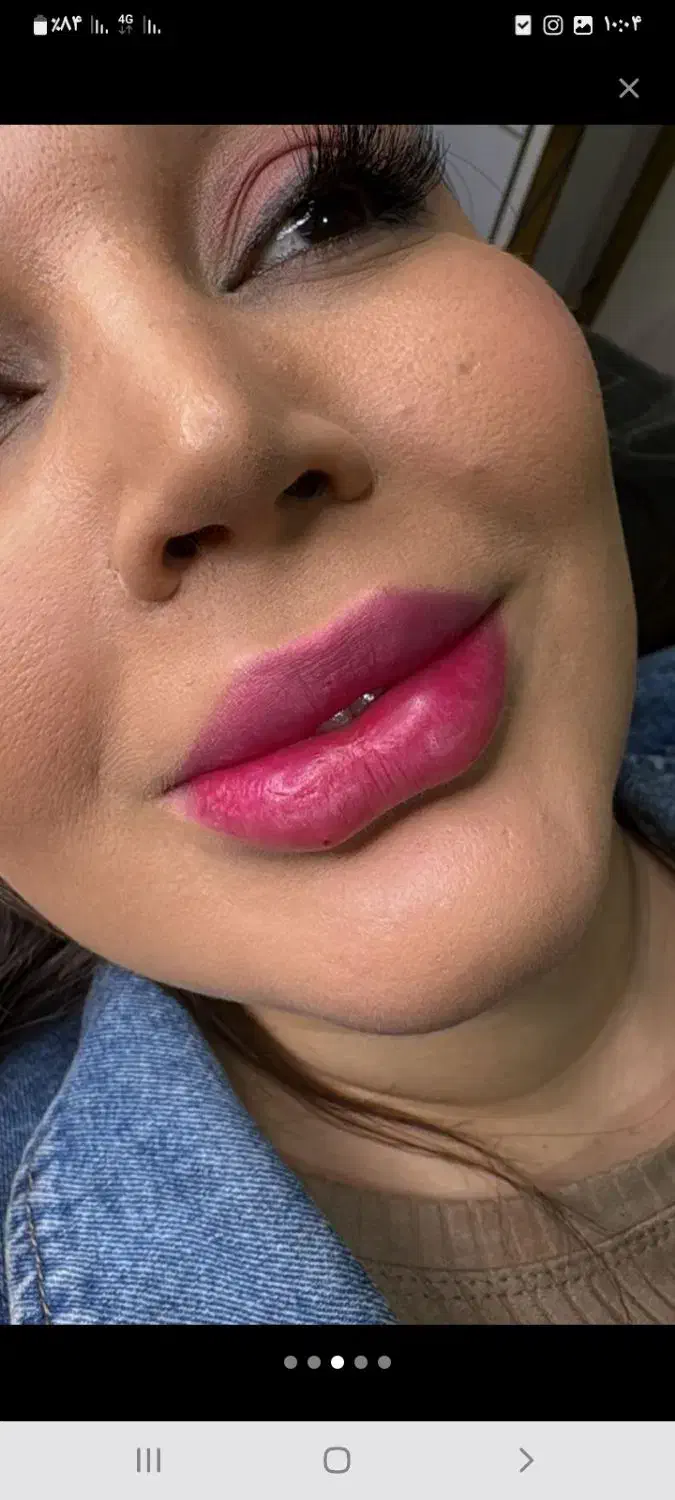 تزریق ژل بوتاکس لیفت مادلینگ و کانتورینگ کلینیک|خدمات آرایشگری و زیبایی|بندرعباس, |دیوار