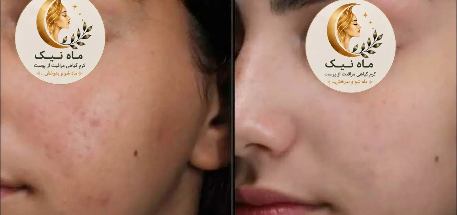 کرم تخصصی چندمنظوره ماه نیک|آرایشی، بهداشتی، درمانی|تهران, شهرک پرواز|دیوار