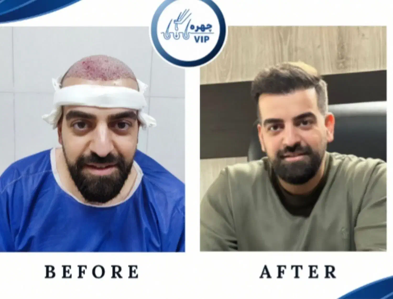 کاشت مو پرتراکم|خدمات آرایشگری و زیبایی|تهران, ونک|دیوار