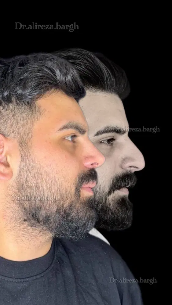 عمل جراحی بینی با ۵۰درصد تخفیف|خدمات زیبایی و سلامت|تهران, نظامی گنجوی (توانیر)|دیوار