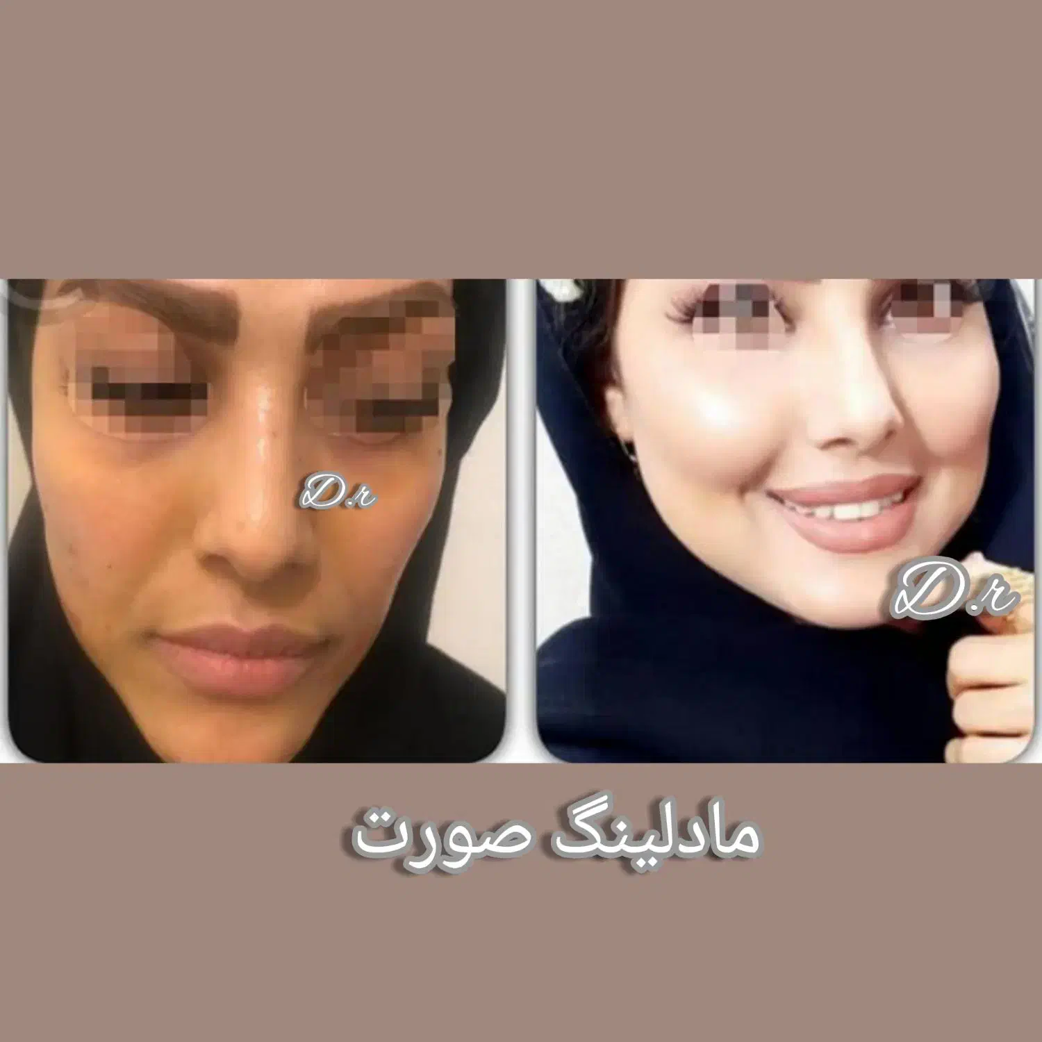 ساکش غبغب تزریق .باسن.شکم|خدمات آرایشگری و زیبایی|کرمانشاه, |دیوار