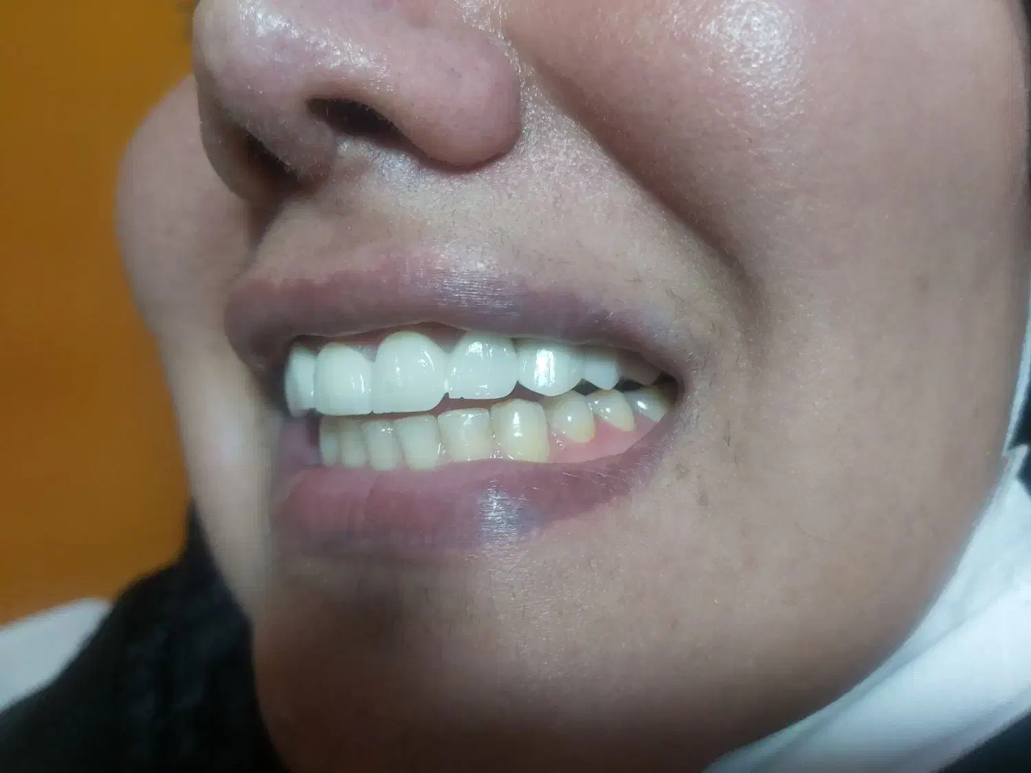 عصبکشی پر کردن ۱۳۰۰ روکش فروش رادیوگرافی|خدمات آرایشگری و زیبایی|مرند, |دیوار