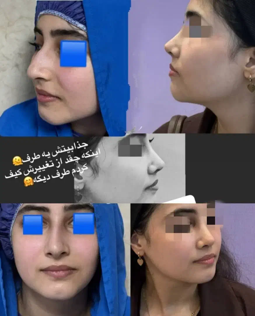 جشنواه ویژه  خدمات   عمل بینی لیپو ساکشن|خدمات آرایشگری و زیبایی|اهواز, کیانپارس |دیوار