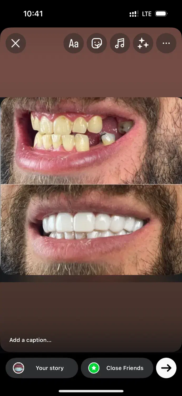 کامپوزیت متحرک دندان فوری|خدمات آرایشگری و زیبایی|مشهد, جانباز|دیوار