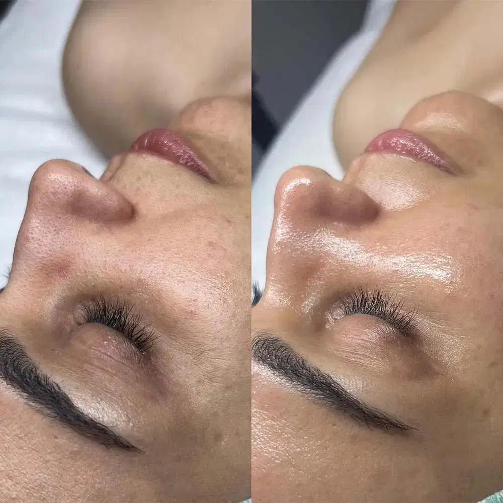 فیشیال و پاکسازی  vip درمان تخصصی جوش. لک. و منافذ|خدمات آرایشگری و زیبایی|مشهد, اقبال|دیوار