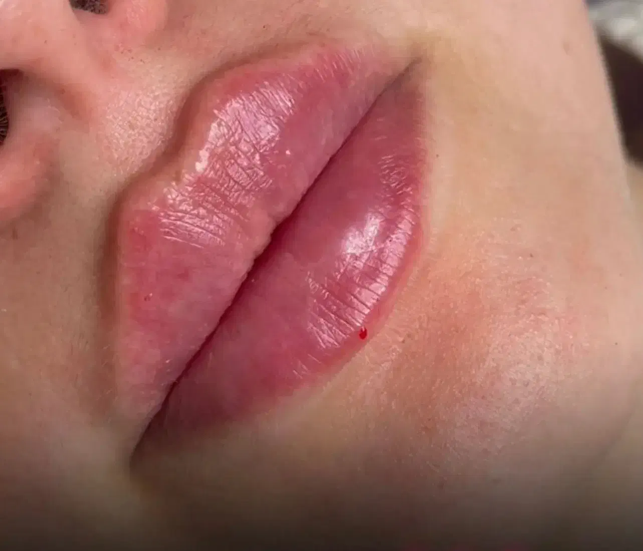 جشنواره پاییزی تخفیف ژل و بوتاکس توسط پزشک|خدمات آرایشگری و زیبایی|یاسوج, |دیوار