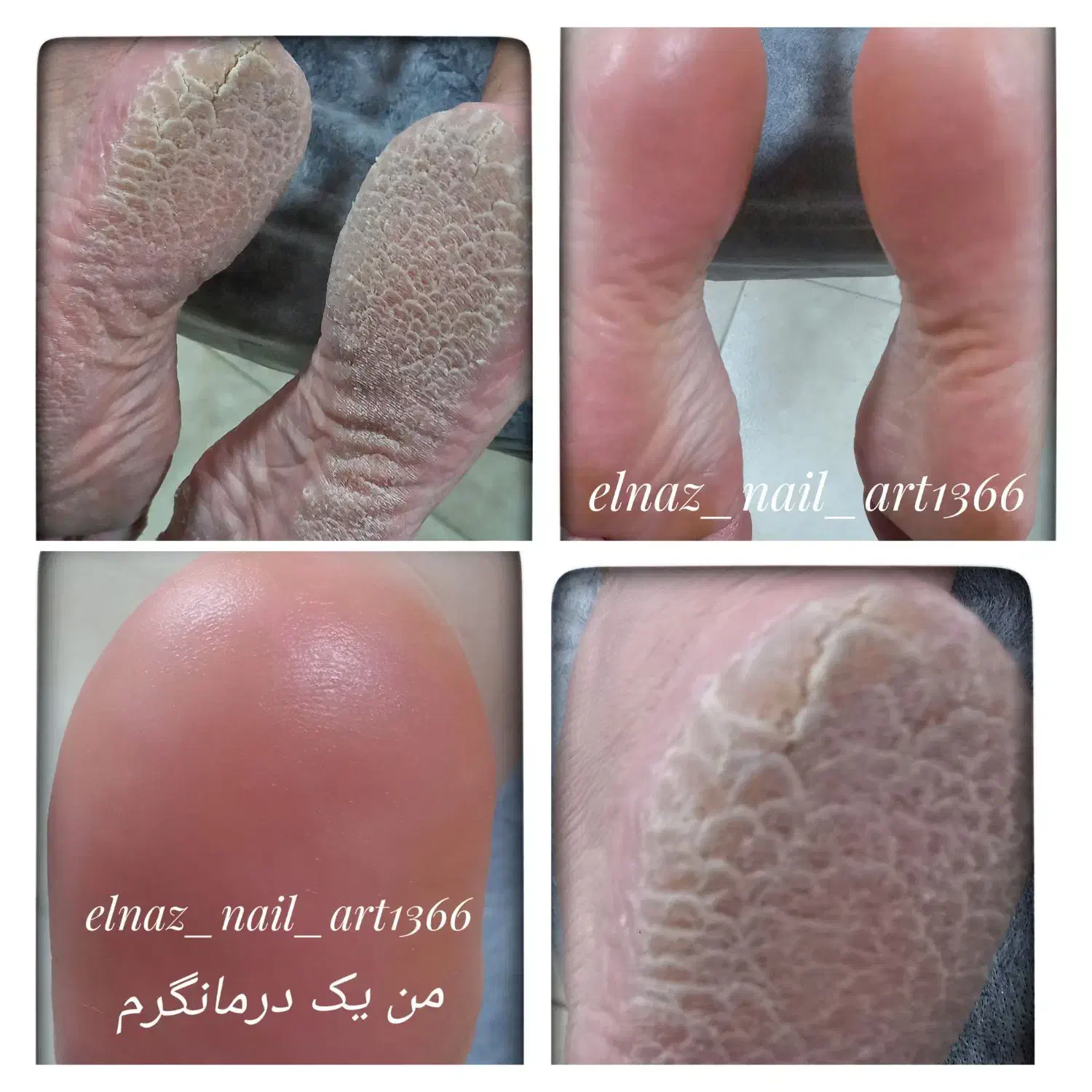 رفع ترک و تیرگی پا کفسابی پدیکور ۳۵۰ در یک جلسه|خدمات آرایشگری و زیبایی|بروجرد, |دیوار