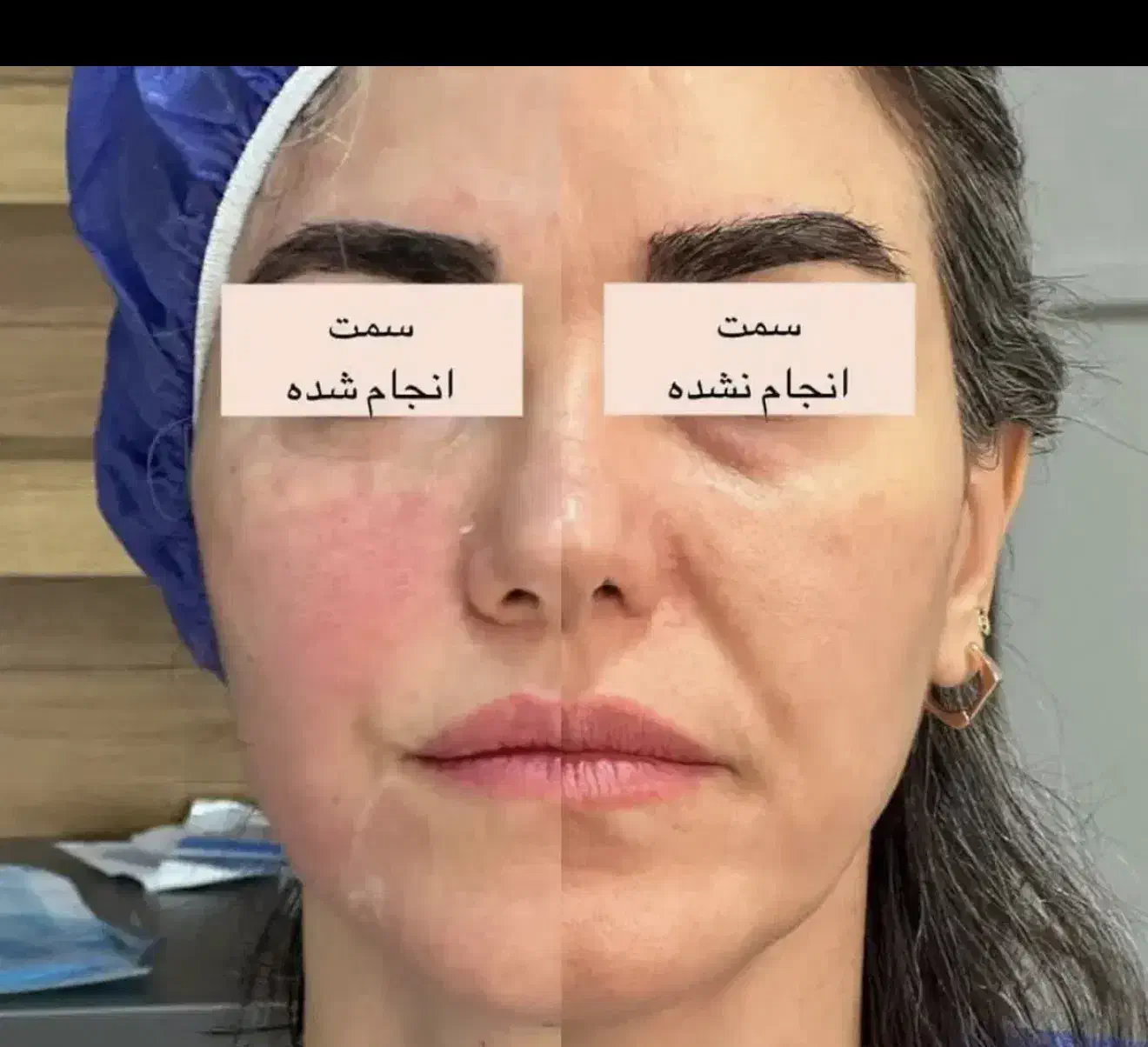 پکیج اقتصادی جوانساز اندولیفت هایفوتراپ دکترداریوش|خدمات آرایشگری و زیبایی|مشهد, راهنمایی|دیوار