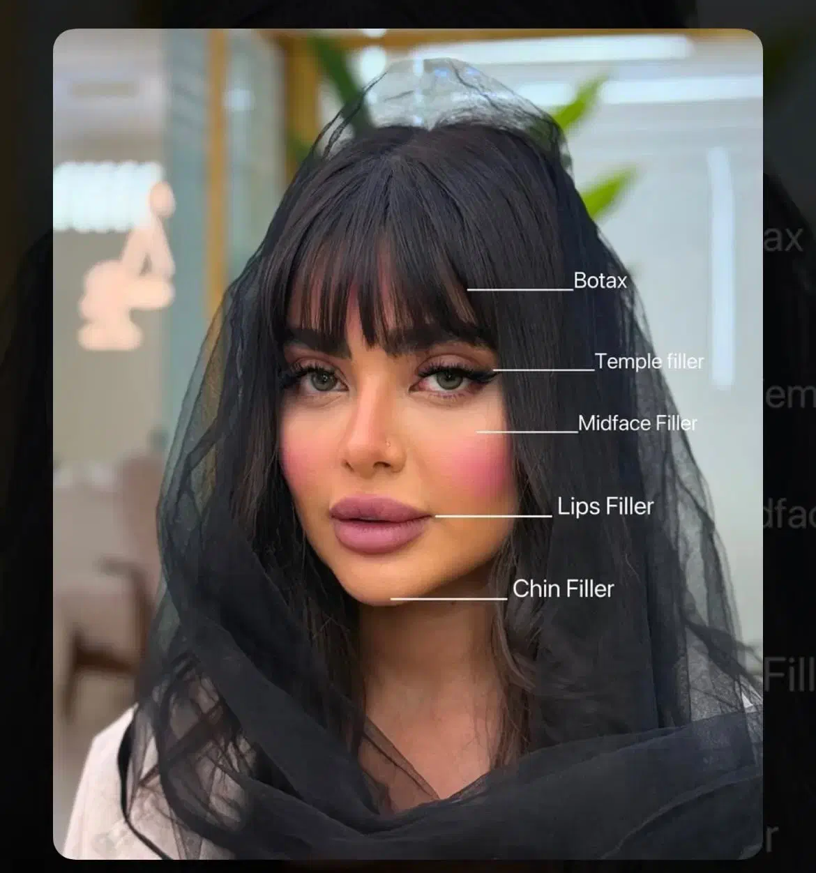 جشنواره تخفیفی ژل و بوتاکس/وام/اقساطی|خدمات آرایشگری و زیبایی|ساری, |دیوار