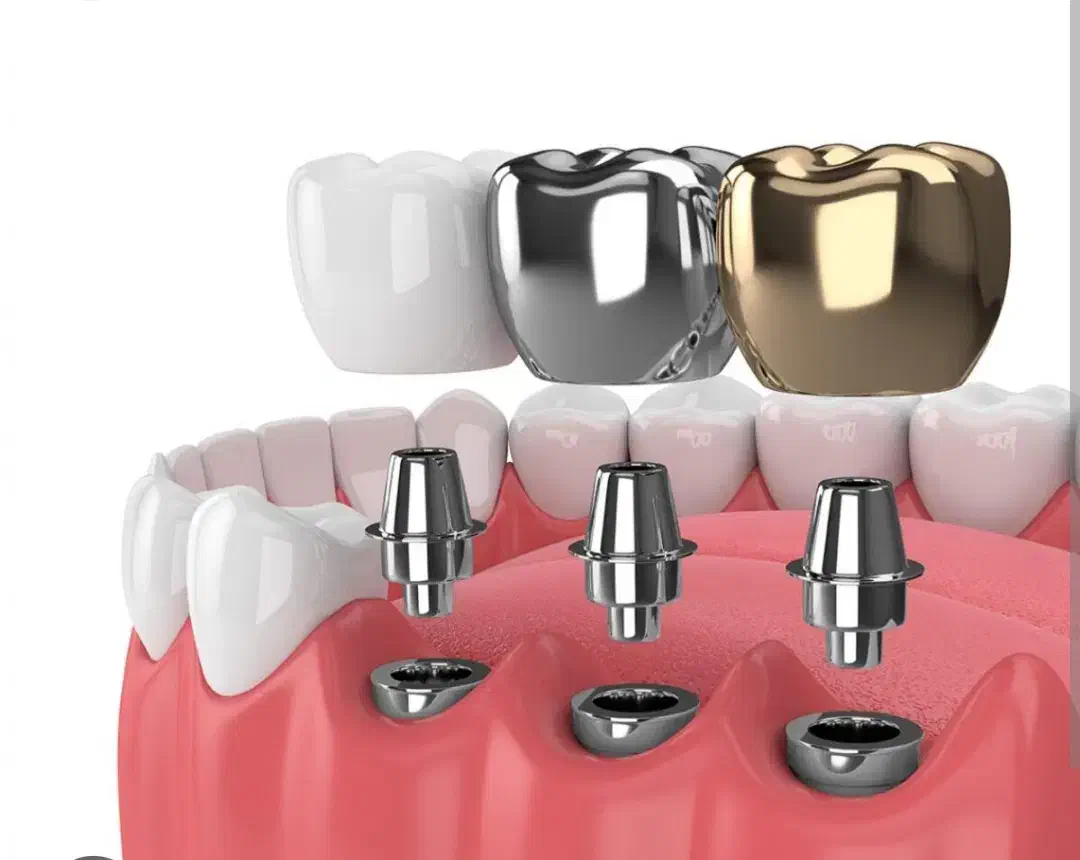 دندانپزشکی/ متخصص جراح فک ولثه /ایمپلنت 9میلیون|خدمات آرایشگری و زیبایی|مشهد, احمدآباد|دیوار