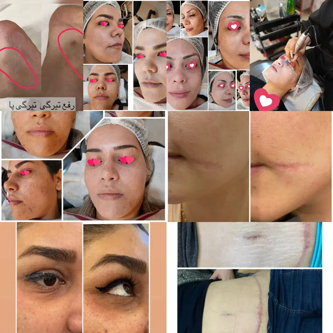 آموزش مزو نیدلینگ +تکنیک پوست کره ای+کاموفلاژ بدن|خدمات آموزشی|مشهد, هنرستان|دیوار