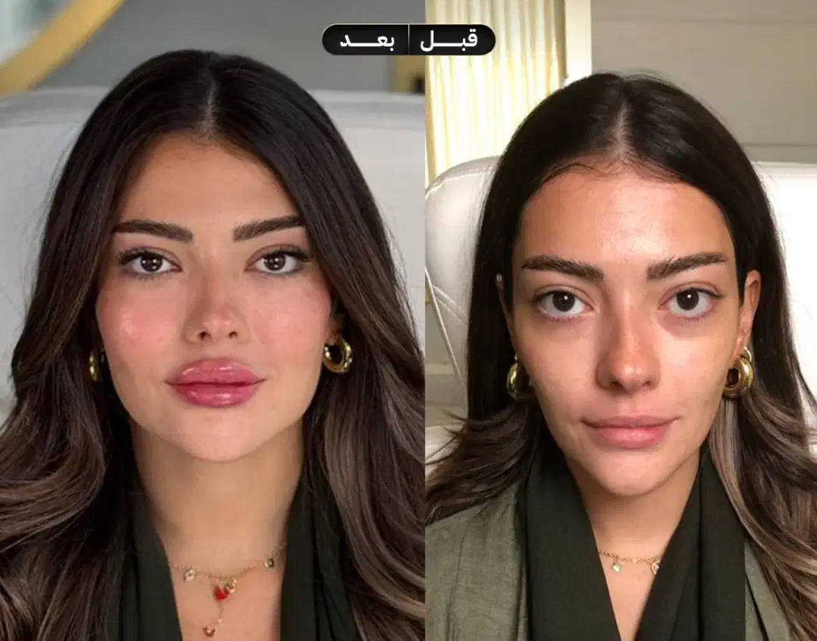 جشنواره ژل لب گونه چونه زاویه فک فیلرزیرچشم بوتاکس|خدمات آرایشگری و زیبایی|تهران, قلهک|دیوار