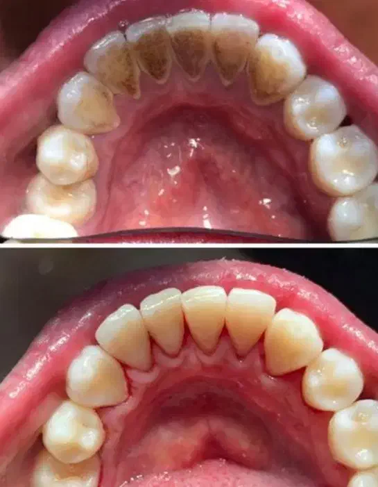 پاکسازی حرفه ای دندان|آرایشی، بهداشتی، درمانی|یزد, |دیوار