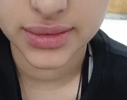 تزریق ژل و بوتاکس بصورت نقد و اقساط|خدمات آرایشگری و زیبایی|فولادشهر, ورزشگاه فولادشهر|دیوار