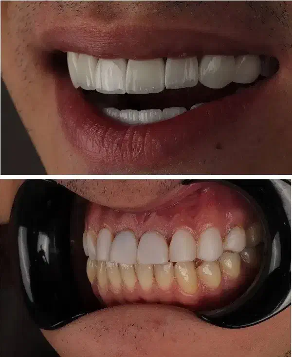 دندانپزشک اقساط کامپوزیت لمینیت لب شیشه ای بلیچینگ|خدمات آرایشگری و زیبایی|مشهد, سجاد شهر|دیوار