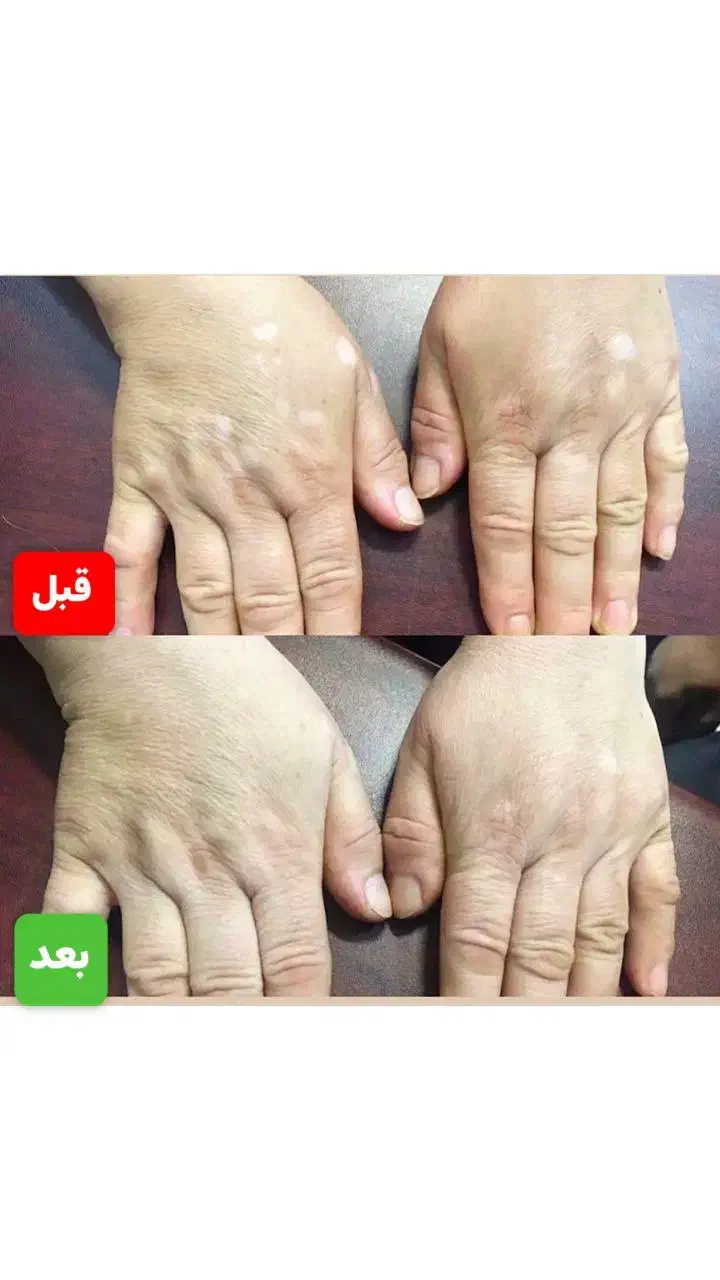 درمان پیسی وپسو ریازیس واگزما دائمی|خدمات آرایشگری و زیبایی|سمنان, |دیوار