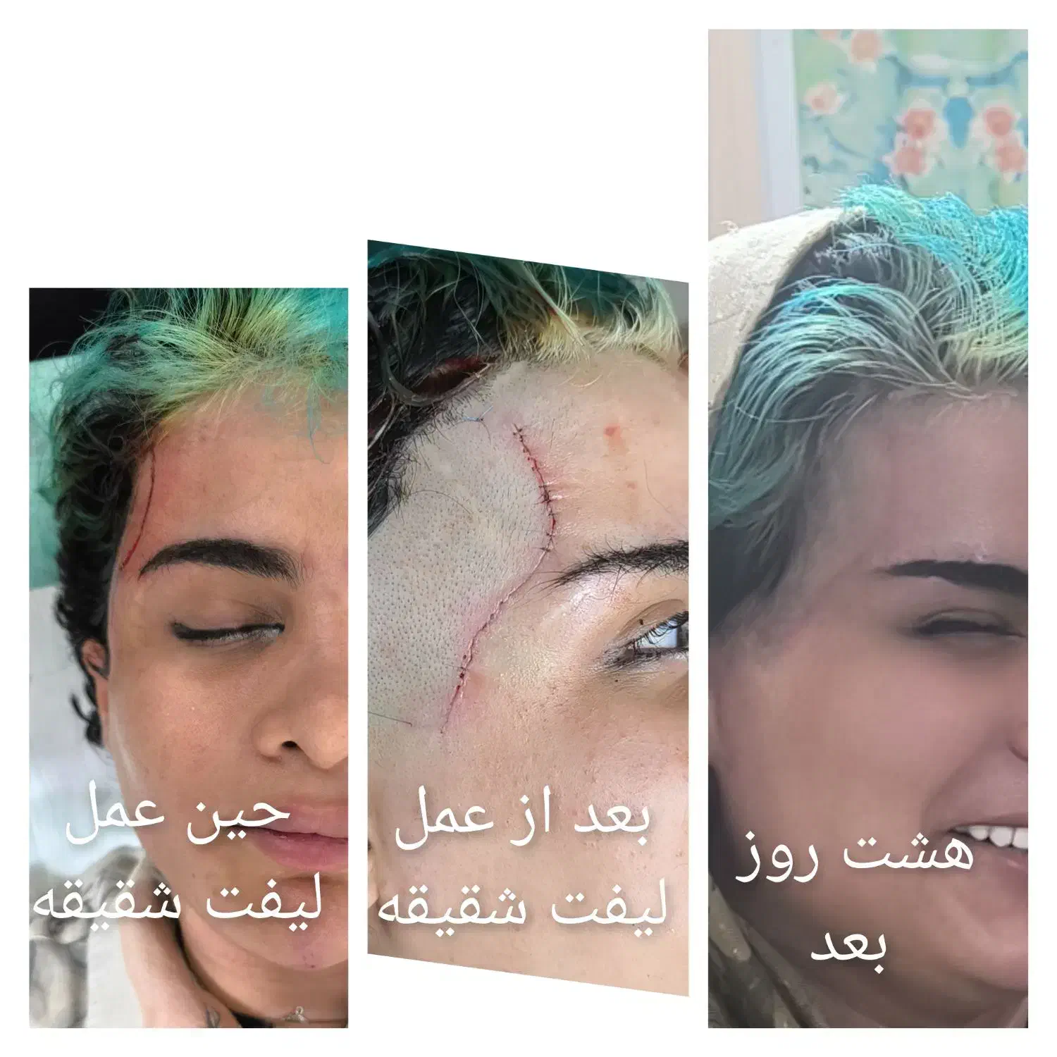 لیفت شقیقه،جای زخم(اسکار) بلفاروبوتاکس فیلر|خدمات آرایشگری و زیبایی|اهواز, زیتون کارگری|دیوار