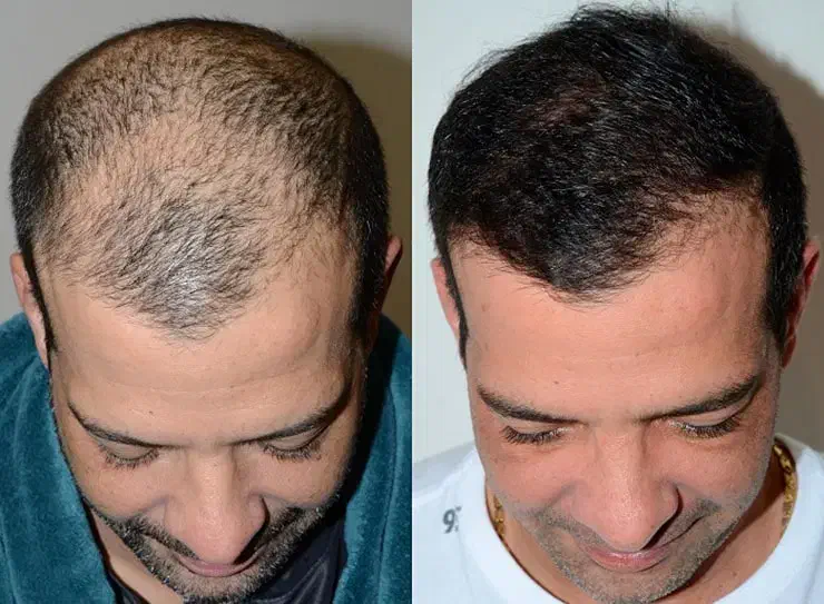 کاشت مو زیر ۱۰ میلیون بیمارستان فوق تخصصی پاستور|خدمات آرایشگری و زیبایی|قزوین, |دیوار