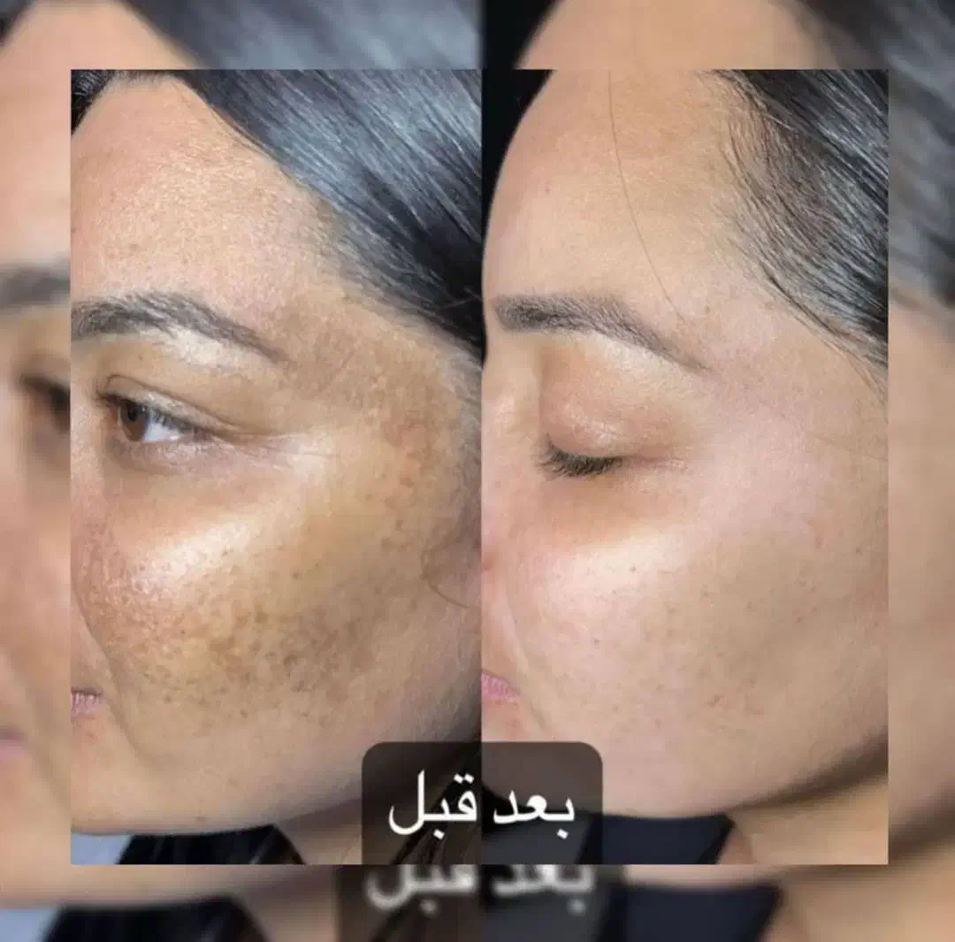 کرم سفیدکننده(آنتی استاین) ترکیب آمپولی|آرایشی، بهداشتی، درمانی|بم, |دیوار