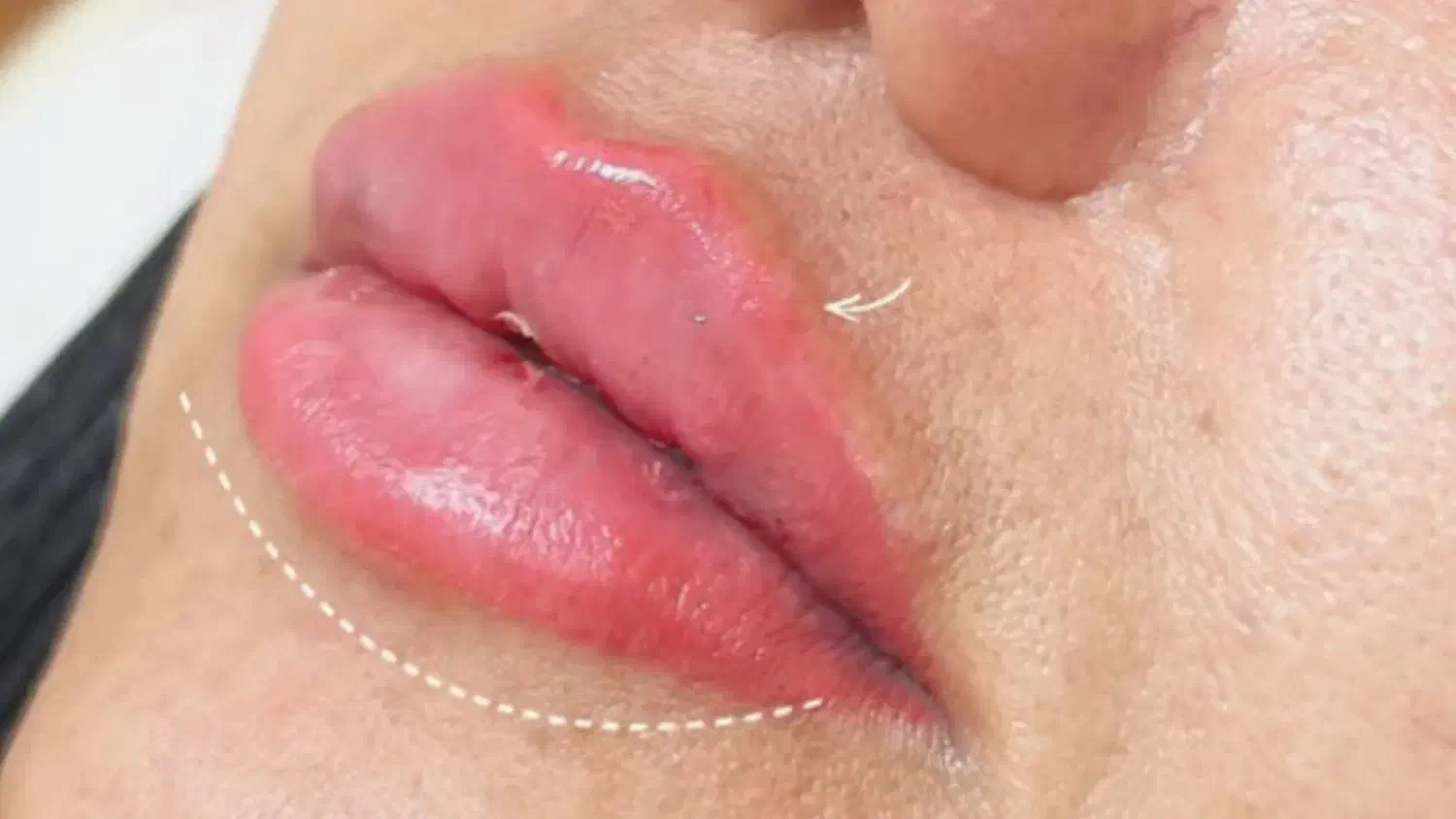تزریق ژل لب،بوتاکس،مزو تراپی،هایفو تراپی،لیزر|خدمات آرایشگری و زیبایی|فردیس, شهرک ارم|دیوار