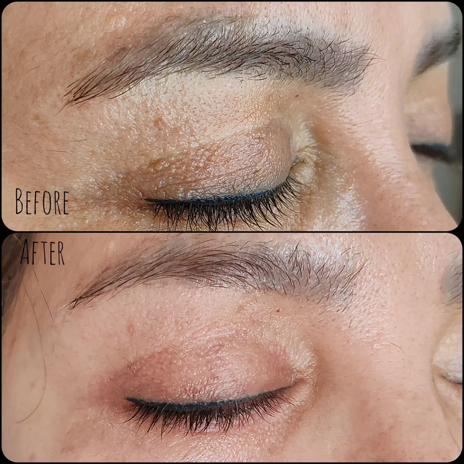 رفع اسکار بلفاروپلاستی بدون بازگشت|خدمات آرایشگری و زیبایی|اصفهان, چشمه باقرخان|دیوار