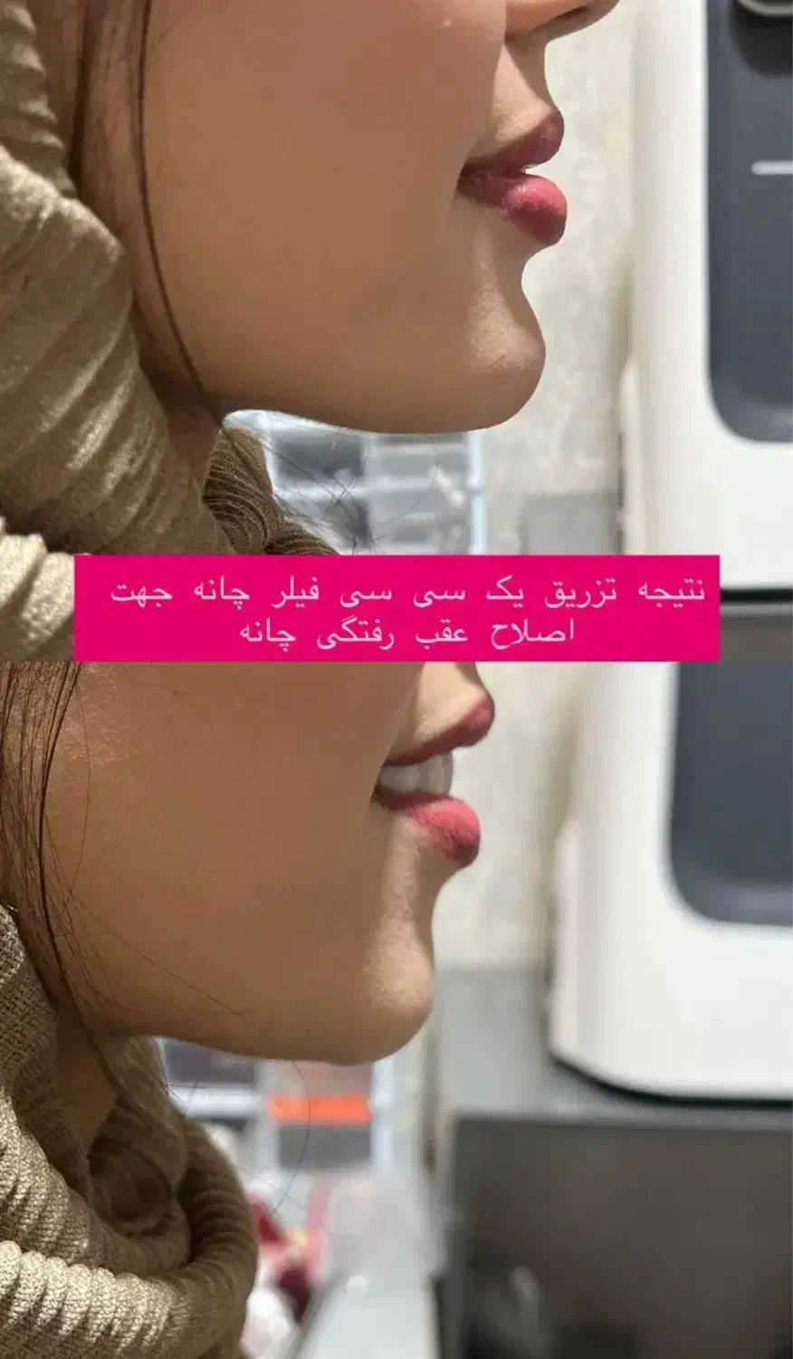 ژل وبوتاکس فیلرمزوپی ارپی آنزیم هایفوبلفاروپلاستی|خدمات آرایشگری و زیبایی|تبریز, |دیوار