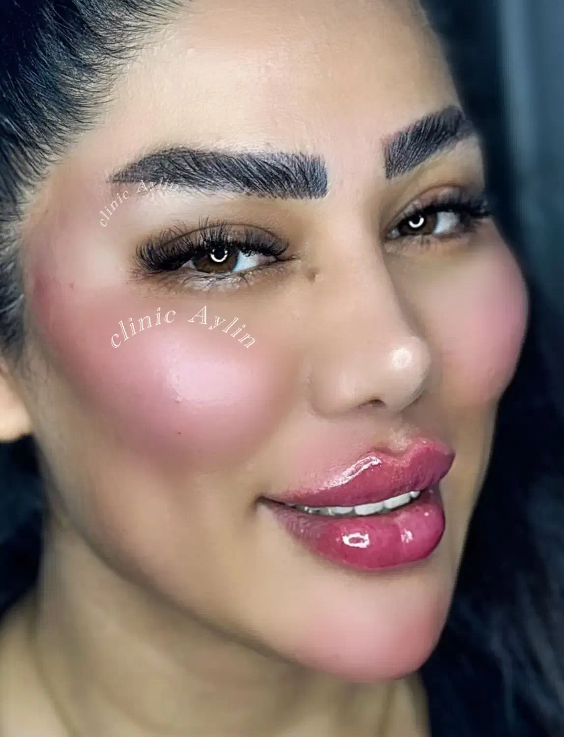 ژل لب فیلر بوتاکس مزو جوانسازی کانتوریگ لیفت نخ|خدمات آرایشگری و زیبایی|تهران, پونک|دیوار