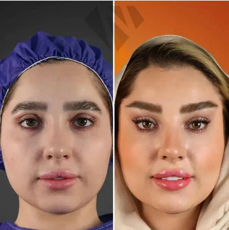 جشنواره تکرار نشدنی ساکشن غبغب و ..کلینیک پالادیوم|خدمات آرایشگری و زیبایی|شیراز, معالیآباد|دیوار