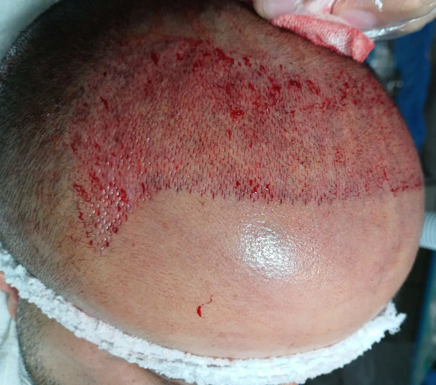 کاشت موی طبیعی فول تراکم|خدمات آرایشگری و زیبایی|ساری, |دیوار