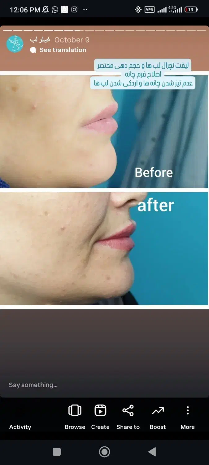 خدمات زیبایی تزریق فیلر ،بوتاکس و لیزر در مطب پزشک|خدمات آرایشگری و زیبایی|قم, نیروگاه|دیوار